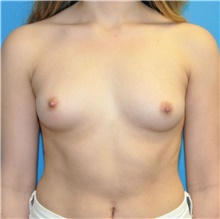 Breast Augmentation Before Photo by Joshua Cooper, MD; Seattle, WA - Case 42603