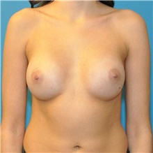 Breast Augmentation After Photo by Joshua Cooper, MD; Seattle, WA - Case 42613