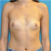 Breast Augmentation Before Photo by Joshua Cooper, MD; Seattle, WA - Case 42613