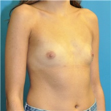 Breast Augmentation Before Photo by Joshua Cooper, MD; Seattle, WA - Case 42613