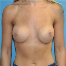 Breast Augmentation After Photo by Joshua Cooper, MD; Seattle, WA - Case 42792