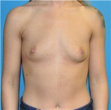 Breast Augmentation Before Photo by Joshua Cooper, MD; Seattle, WA - Case 42792