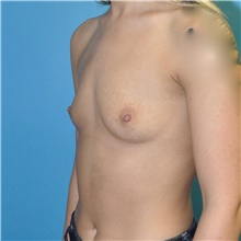 Breast Augmentation Before Photo by Joshua Cooper, MD; Seattle, WA - Case 42792