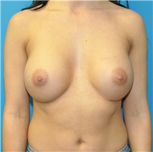 Breast Augmentation After Photo by Joshua Cooper, MD; Seattle, WA - Case 42959