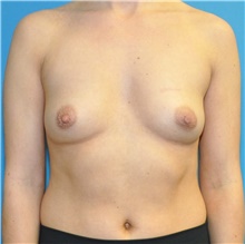 Breast Augmentation Before Photo by Joshua Cooper, MD; Seattle, WA - Case 42959