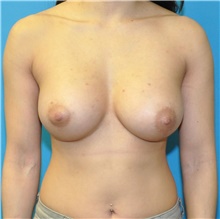 Breast Augmentation After Photo by Joshua Cooper, MD; Seattle, WA - Case 42966