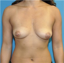 Breast Augmentation Before Photo by Joshua Cooper, MD; Seattle, WA - Case 42966