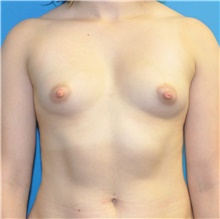 Breast Augmentation Before Photo by Joshua Cooper, MD; Seattle, WA - Case 42996