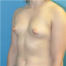 Breast Augmentation Before Photo by Joshua Cooper, MD; Seattle, WA - Case 42996