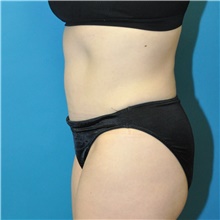 Tummy Tuck After Photo by Joshua Cooper, MD; Seattle, WA - Case 43143