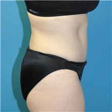 Tummy Tuck After Photo by Joshua Cooper, MD; Seattle, WA - Case 43143