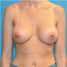 Breast Augmentation After Photo by Joshua Cooper, MD; Seattle, WA - Case 43169