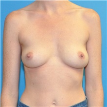 Breast Augmentation Before Photo by Joshua Cooper, MD; Seattle, WA - Case 43169