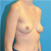 Breast Augmentation Before Photo by Joshua Cooper, MD; Seattle, WA - Case 43169