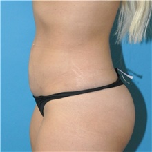 Liposuction After Photo by Joshua Cooper, MD; Seattle, WA - Case 43203