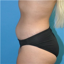 Liposuction Before and After Photos  American Society of Plastic Surgeons