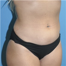 Liposuction Before Photo by Joshua Cooper, MD; Seattle, WA - Case 43203