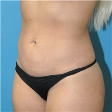 Liposuction After Photo by Joshua Cooper, MD; Seattle, WA - Case 43203
