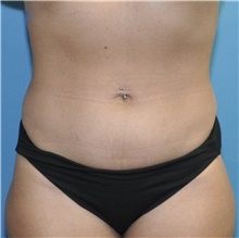 Liposuction Before Photo by Joshua Cooper, MD; Seattle, WA - Case 43203