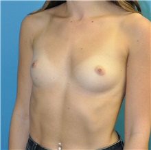 Breast Augmentation Before Photo by Joshua Cooper, MD; Seattle, WA - Case 43205