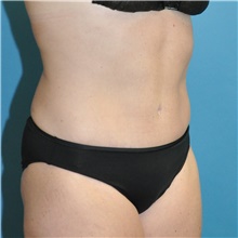 Tummy Tuck After Photo by Joshua Cooper, MD; Seattle, WA - Case 43214