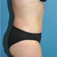 Tummy Tuck After Photo by Joshua Cooper, MD; Seattle, WA - Case 43214