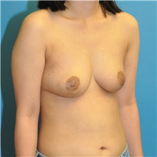 Breast Reduction After Photo by Joshua Cooper, MD; Seattle, WA - Case 44348