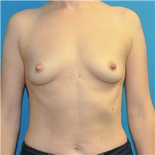 Breast Augmentation Before Photo by Joshua Cooper, MD; Seattle, WA - Case 45706
