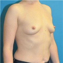 Breast Augmentation Before Photo by Joshua Cooper, MD; Seattle, WA - Case 45706