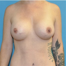 Breast Augmentation After Photo by Joshua Cooper, MD; Seattle, WA - Case 45708