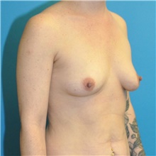 Breast Augmentation Before Photo by Joshua Cooper, MD; Seattle, WA - Case 45708