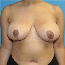Breast Reduction After Photo by Joshua Cooper, MD; Seattle, WA - Case 45710