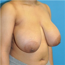 Breast Reduction Before Photo by Joshua Cooper, MD; Seattle, WA - Case 45710