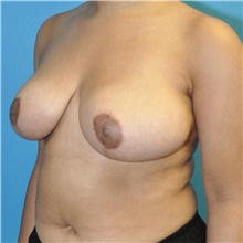Breast Reduction After Photo by Joshua Cooper, MD; Seattle, WA - Case 45710