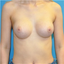Breast Augmentation After Photo by Joshua Cooper, MD; Seattle, WA - Case 46097
