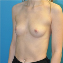 Breast Augmentation Before Photo by Joshua Cooper, MD; Seattle, WA - Case 46097