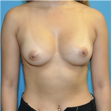 Breast Augmentation After Photo by Joshua Cooper, MD; Seattle, WA - Case 46099