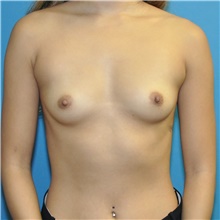 Breast Augmentation Before Photo by Joshua Cooper, MD; Seattle, WA - Case 46099