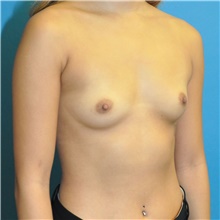 Breast Augmentation Before Photo by Joshua Cooper, MD; Seattle, WA - Case 46099