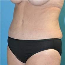 Tummy Tuck After Photo by Joshua Cooper, MD; Seattle, WA - Case 46101