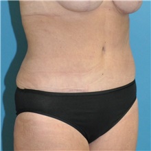 Tummy Tuck After Photo by Joshua Cooper, MD; Seattle, WA - Case 46101