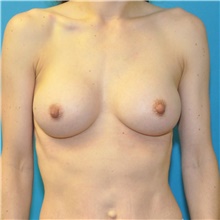 Breast Augmentation After Photo by Joshua Cooper, MD; Seattle, WA - Case 46290