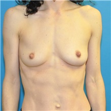 Breast Augmentation Before Photo by Joshua Cooper, MD; Seattle, WA - Case 46290