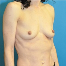 Breast Augmentation Before Photo by Joshua Cooper, MD; Seattle, WA - Case 46290
