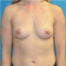 Breast Augmentation Before Photo by Joshua Cooper, MD; Seattle, WA - Case 46375