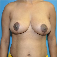 Breast Reduction After Photo by Joshua Cooper, MD; Seattle, WA - Case 46383