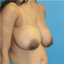 Breast Reduction Before Photo by Joshua Cooper, MD; Seattle, WA - Case 46383