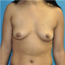 Breast Augmentation Before Photo by Joshua Cooper, MD; Seattle, WA - Case 46528