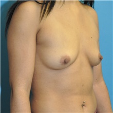 Breast Augmentation Before Photo by Joshua Cooper, MD; Seattle, WA - Case 46528
