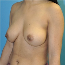 Breast Augmentation After Photo by Joshua Cooper, MD; Seattle, WA - Case 46528